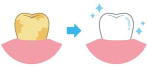 歯が黄ばむ原因と対策